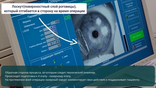 Лазерная коррекция зрения LASIK. С комментариями лазерного хирурга смотреть онлайн