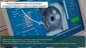 Лазерная коррекция зрения LASIK. С комментариями лазерного хирурга