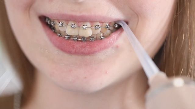 Как правильно использовать ирригатор пациентам с брекет-системой?