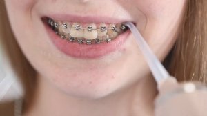 Как правильно использовать ирригатор пациентам с брекет-системой?