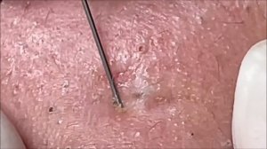 Relaxing Acne Treatment Acnes Treatment  133