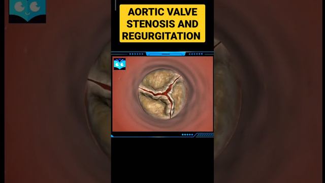 Aortic value stenosis and regurgitation. #studyanimated #biology #animation #science