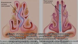 Как лечить заложенный нос без соплей