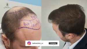 Hair transplant before and after / пересадка волос до и после