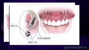Новый метод имплантации зубов.  Что такое мини-импланты? Говорит ЭКСПЕРТ