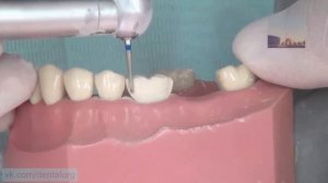 Препарирование под металлическую коронку