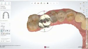3D принтер для стоматологии NextDent 5100. Клинический случай.
