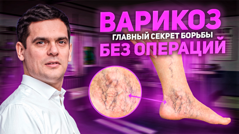 Варикозное Расширение Вен. Просты Действия, Которые Помогут Вам Избавиться от Варикоза