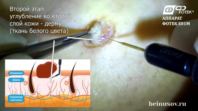 Эксцизионная биопсия пигментного невуса кожи голени методом широкополосной радиоволновой хирургии смотреть онлайн
