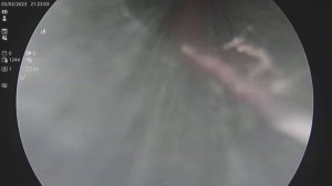 Лапароскопическая аппендэктомия при остром флегмонозном аппендиците от 03.02.2023