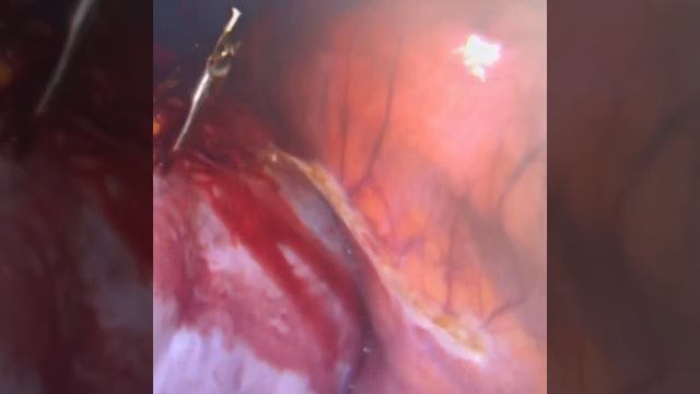 Гигантская киста. Как извлечь? смотреть онлайн