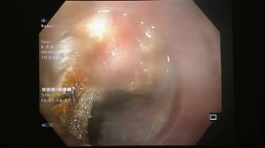 19 Шишин КВ Эндоскопическое лечение дивертикула Ценкера