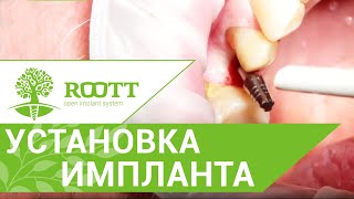 Процесс установки импланта ROOTT безоперационным методом