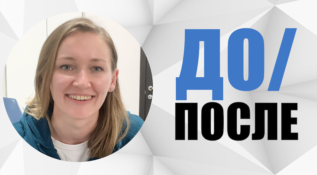 #8 Случай до/после. Ортодонтическое лечение глубокого + перекрестного прикуса.