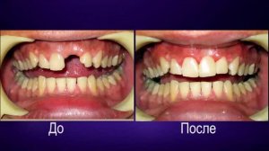 Протезирование зубов