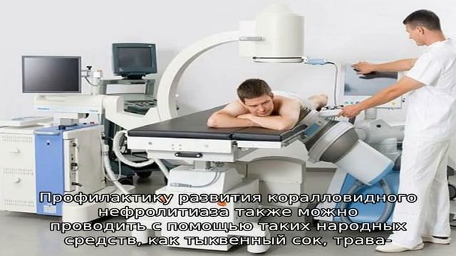 Коралловидные камни в почках
