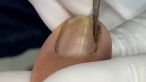 Гнойное лечение ногтей