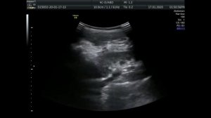 У ребенка киста