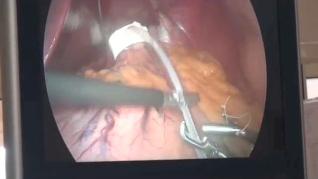 Бандажирование желудка смотреть онлайн