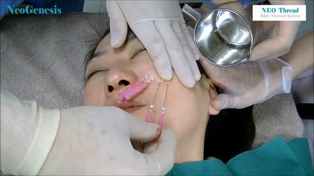 Мезонити NEO, Лицо — ПОЛНАЯ ПРОЦЕДУРА, часть 1 (NEO Thread Operation 1 Face)