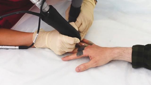 Удаление тату лазером в Клинике Элен – смотреть онлайн видео от ...