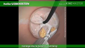 Буйракдаги тошни олиб ташлаш. (ПОКИСТОН, БУЮК БРИТАНИЯ, ФИЛЛИПИН)