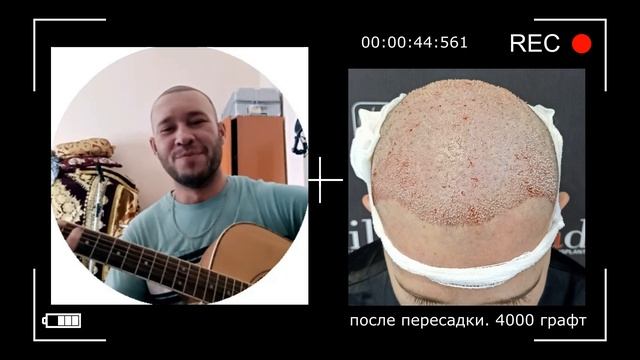 Результат пересадки волос методом FUE 4000 графт.
