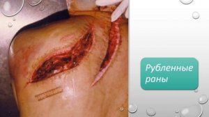 Раны. Лекция. Лицо со шрамом. Как лечить? И как лечить не надо!