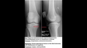 Перелом бугристости большеберцовой кости