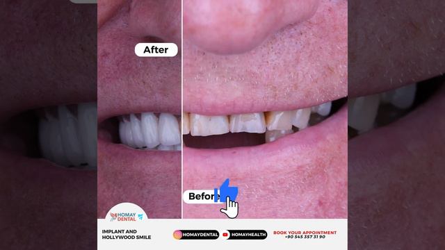 Homay Dental - Implant and hollywood smile