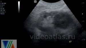 Опухоли почки.