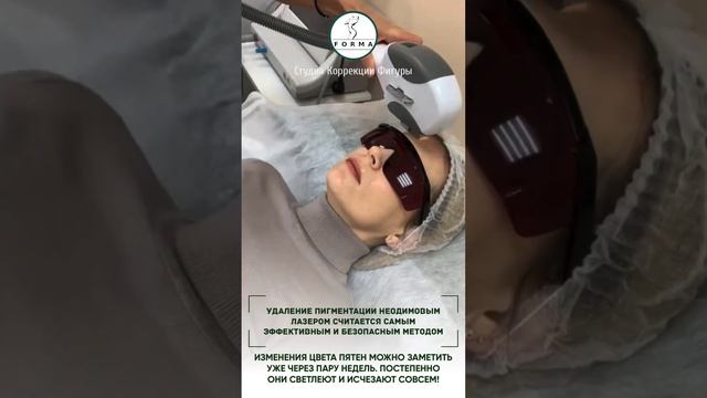 Лечение пигментации НЕОДИМОВЫМ ЛАЗЕРОМ⚡️ смотреть онлайн