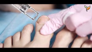 Секретное оружие фармацевтов против грибковых инфекций ногтей - Уксус и аспирин