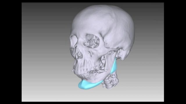 Подтяжка лица  Липофиллинг  Доктор Гурьянов смотреть онлайн