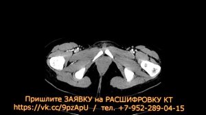 СИНДРОМ верхней брыжеечной артерии на РАСШИФРОВКЕ КТ брюшной полости. Синдром Уилки.