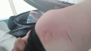 Я упал с лестницы!