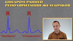 Синдром ранней реполяризации желудочков | ЭКГ