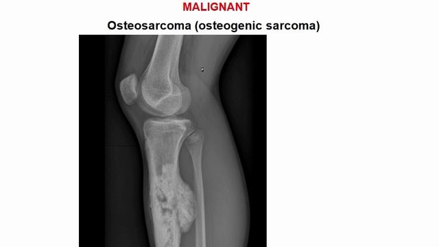 USMLE RX - 8.Анатомия - 3.Патология - 17.Первичные Опухоли Костей