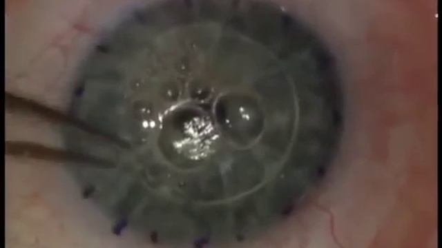 Видео лазерная кератопластика