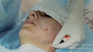 Нитевой лифтинг - этапы процедуры.