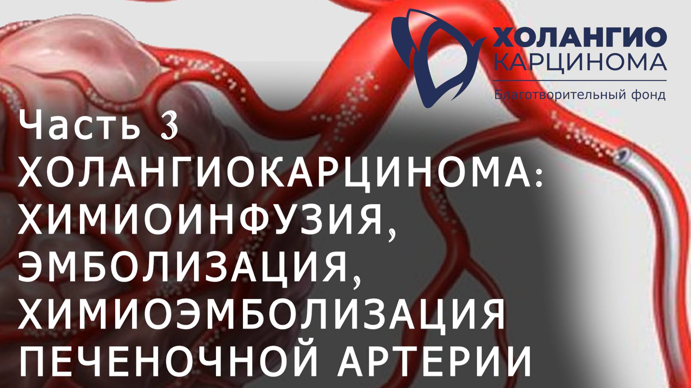 ЧАСТЬ 3. ХОЛАНГИОКАРЦИНОМА: ХИМИОИНФУЗИЯ, ЭМБОЛИЗАЦИЯ, ХИМИОЭМБОЛИЗАЦИЯ ПЕЧЕНОЧНОЙ АРТЕРИИ // РНЦРХТ