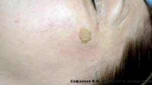 Пигментное пятно, удаление методом высокочастотной электрохирургии