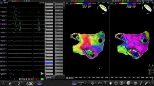 Flow map of left and right flutters