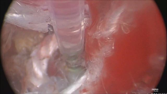 Удаление внутриматочных лигатур диодным лазером Лахта Милон смотреть онлайн