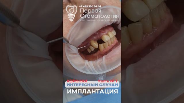 Интересный случай. Коронки. Част № 1. Имплантация зубов пациенту.
