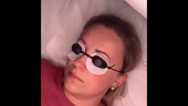 Удаление татуажа лазером. Видео процесса.