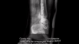 Закрытый перелом лодыжки со смещением моя история 5 часть снимки перелома лодыжки со смещением