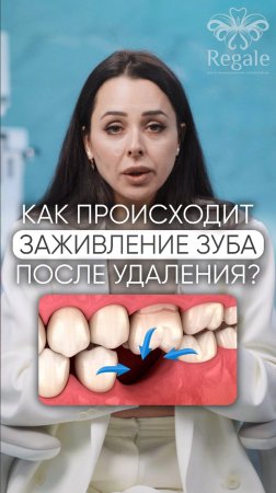 А вы знали, как происходит заживление зуба после удаления?