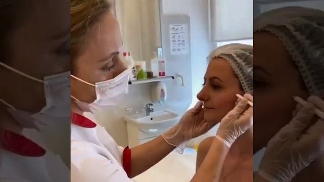 AestheFill филлер на основе полимолочной кислоты