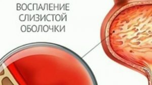 ЦИСТИТ САБАБЛАРИ БЕЛГИЛАРИ ВА ДАВОЛАШ